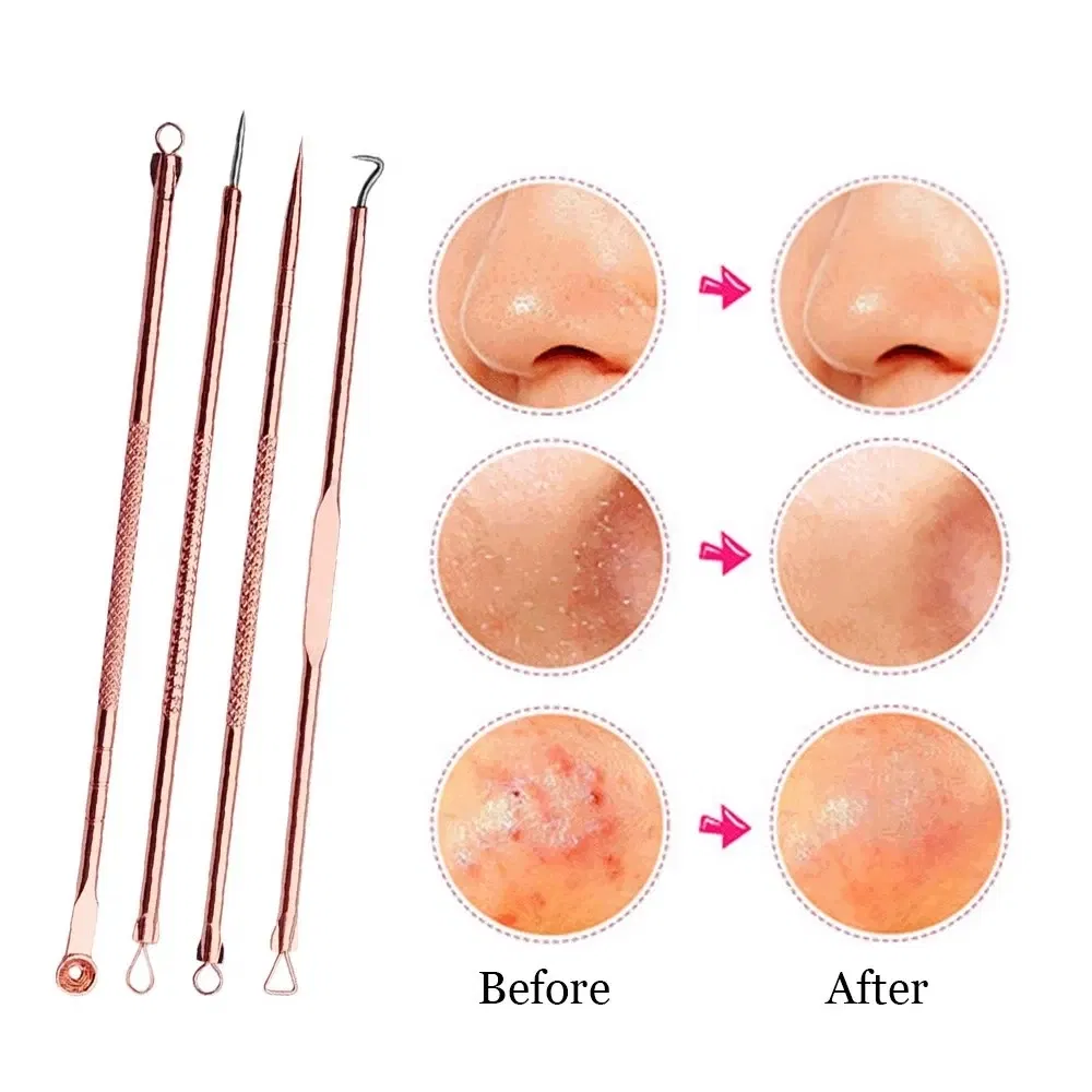 Color: WHITE - 4PCS Stainless Steel Acne Needle Electroplating Colorful Rose Gold Acne Needle Extrusion Blackhead Tool Can Be Customized LOGO - Image 3